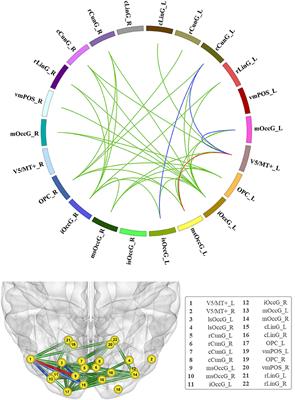 Epilepsy-Related Brain Network Alterations in Patients With Temporal Lobe Glioma in the Left Hemisphere